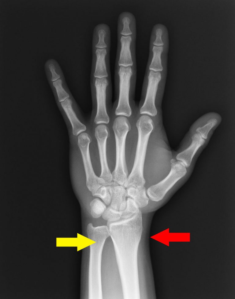 Broken Wrist Treatment In Singapore Liberty Orthopaedic Clinic