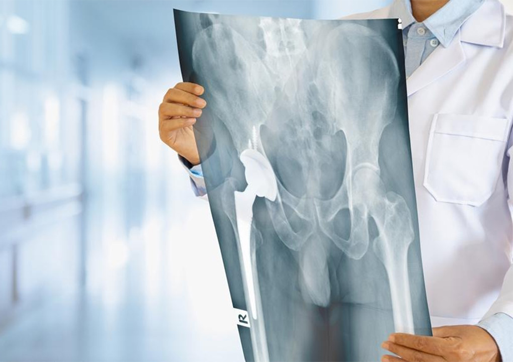 Total Hip Replacement - Liberty Orthopaedic Clinic
