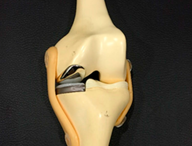 Total Knee replacement