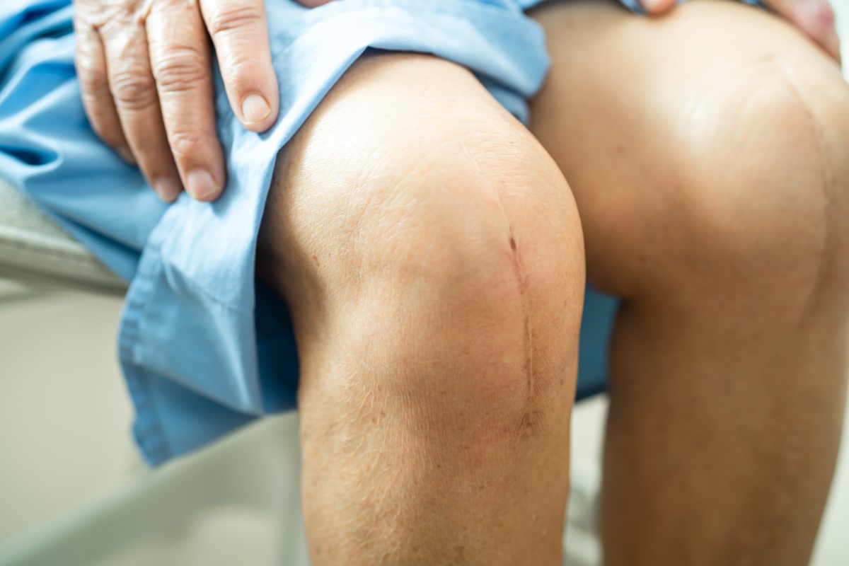 Read more about the article Knee Replacement Surgery: What to Expect Before, During, and After
