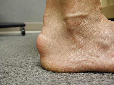 Achilles Tendonitis