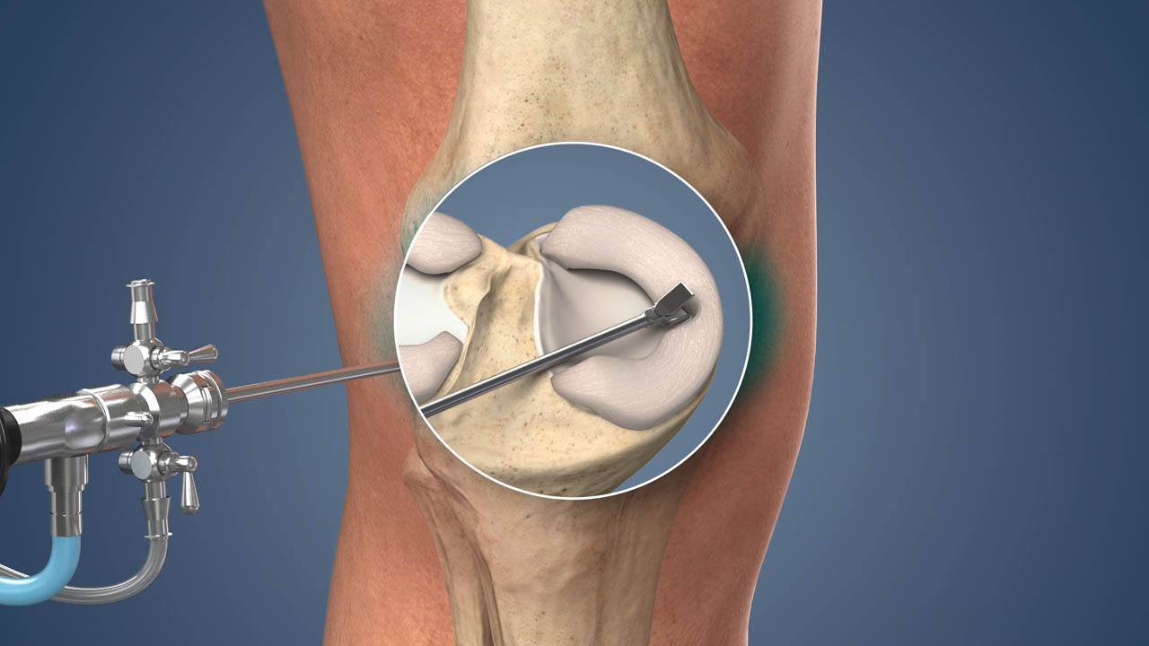 Arthroscopic Surgery