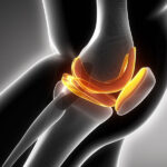 ACL Tears