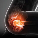 Hip Arthritis