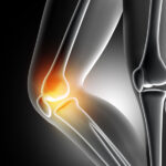 Meniscus Tear
