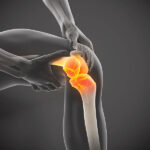 Patellar Tendonitis