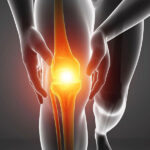 Knee Arthritis