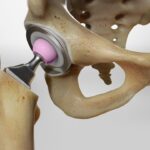 total hip replacement