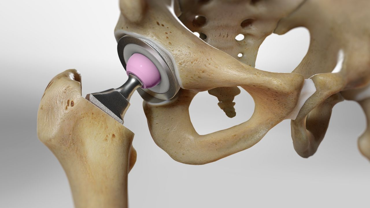 total hip replacement