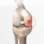 Cartilage Resurfacing Surgery